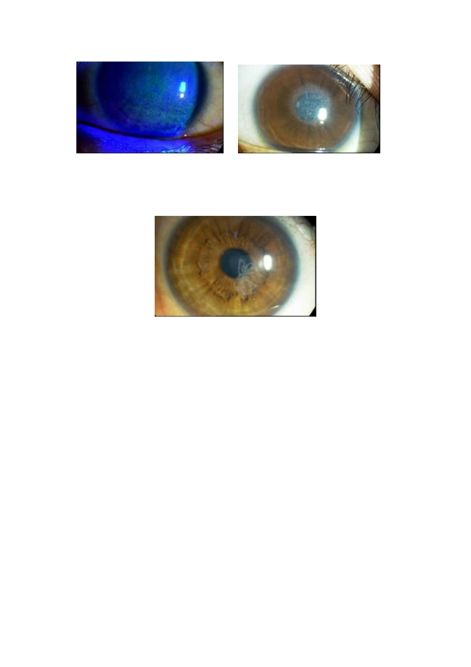 准分子激光屈光性角膜手术后角膜并发症_第2页