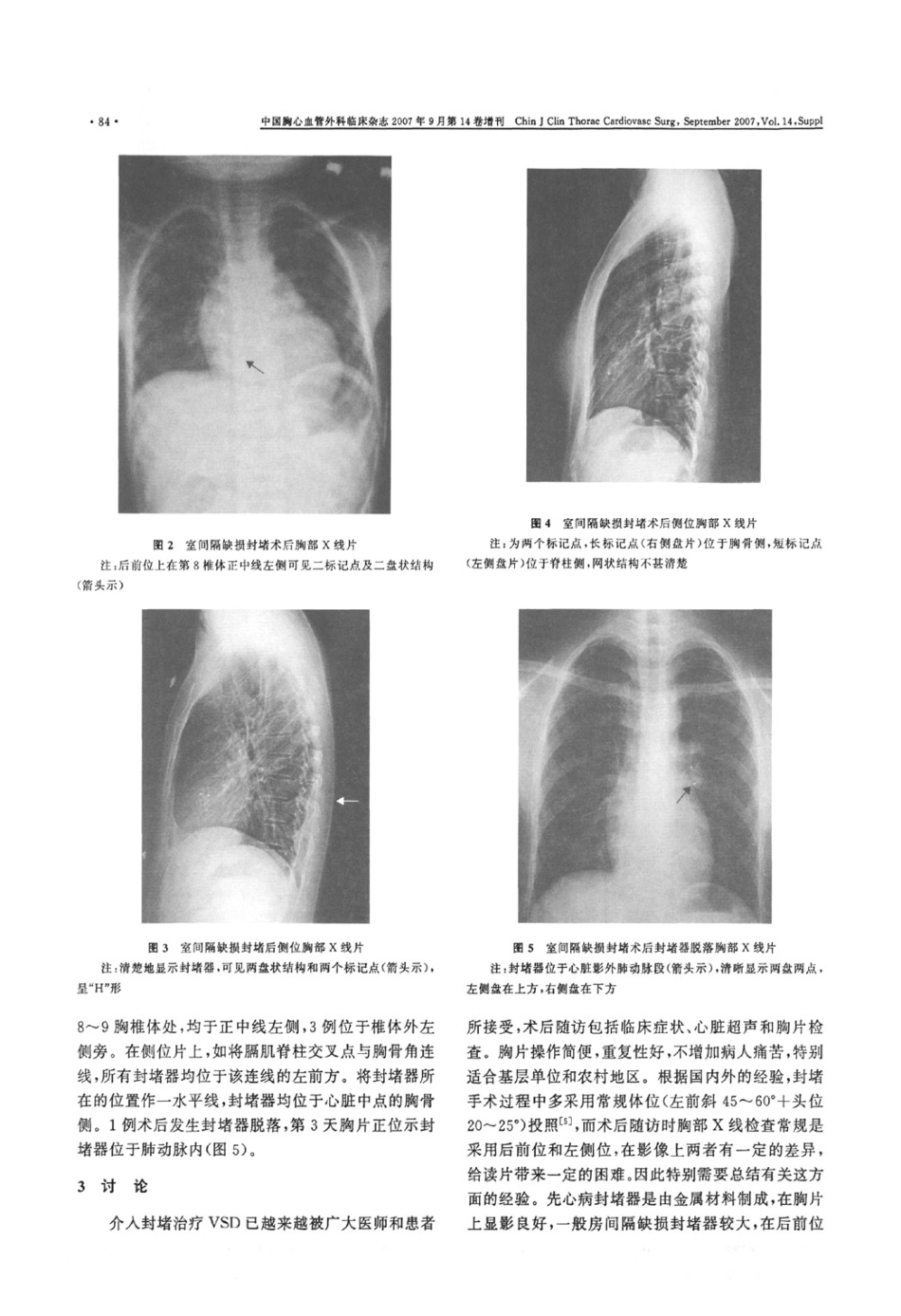 先心病室间隔缺损封堵治疗前后胸部X线表现_第3页