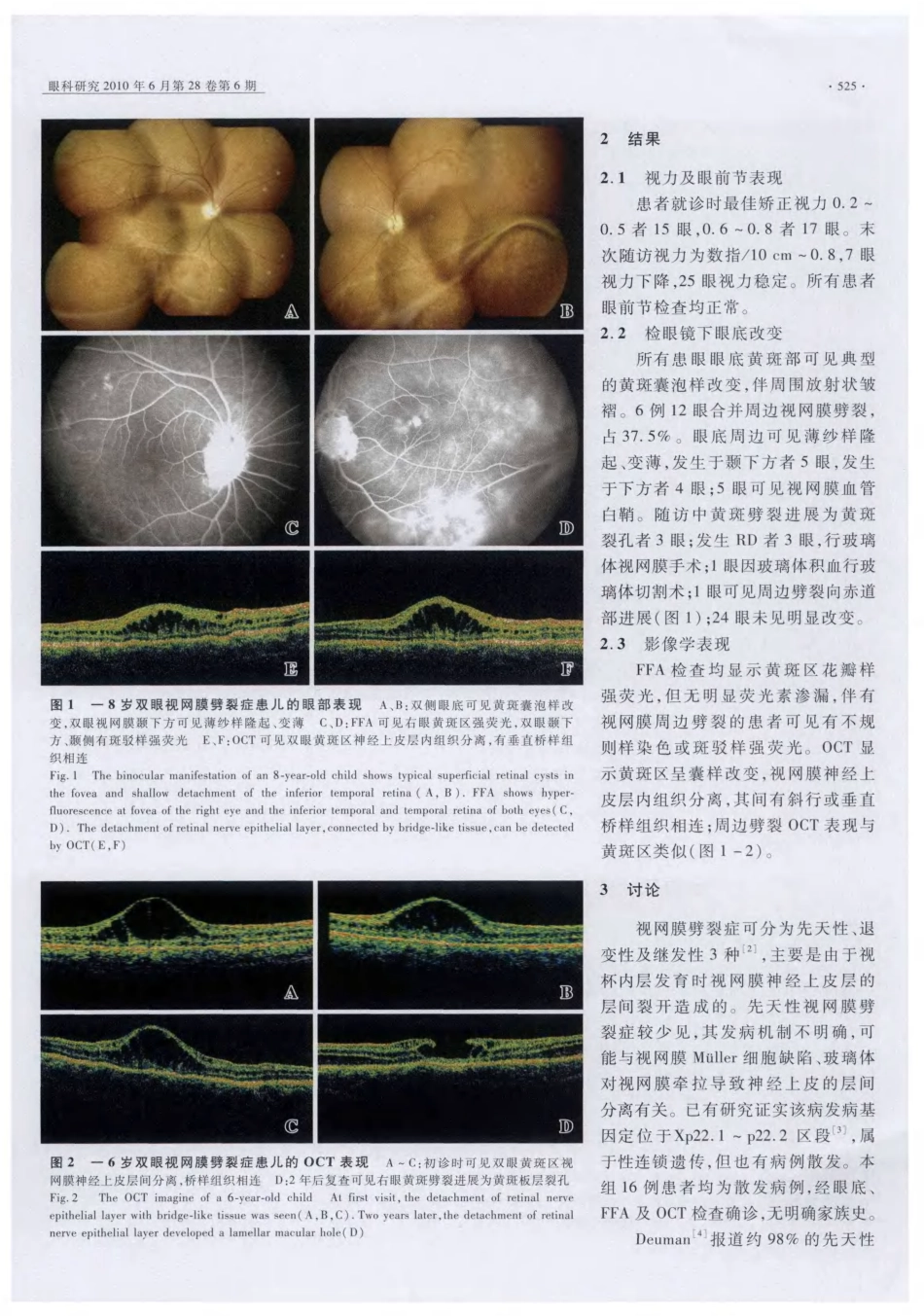 先天性视网膜劈裂症自然病程的临床观察_第2页