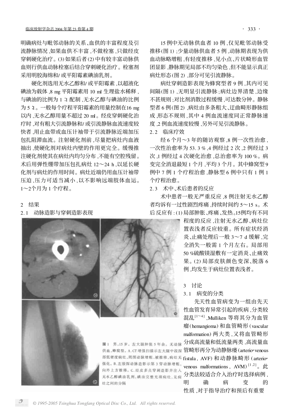 先天性肢体低流量血管畸形的介入治_第2页