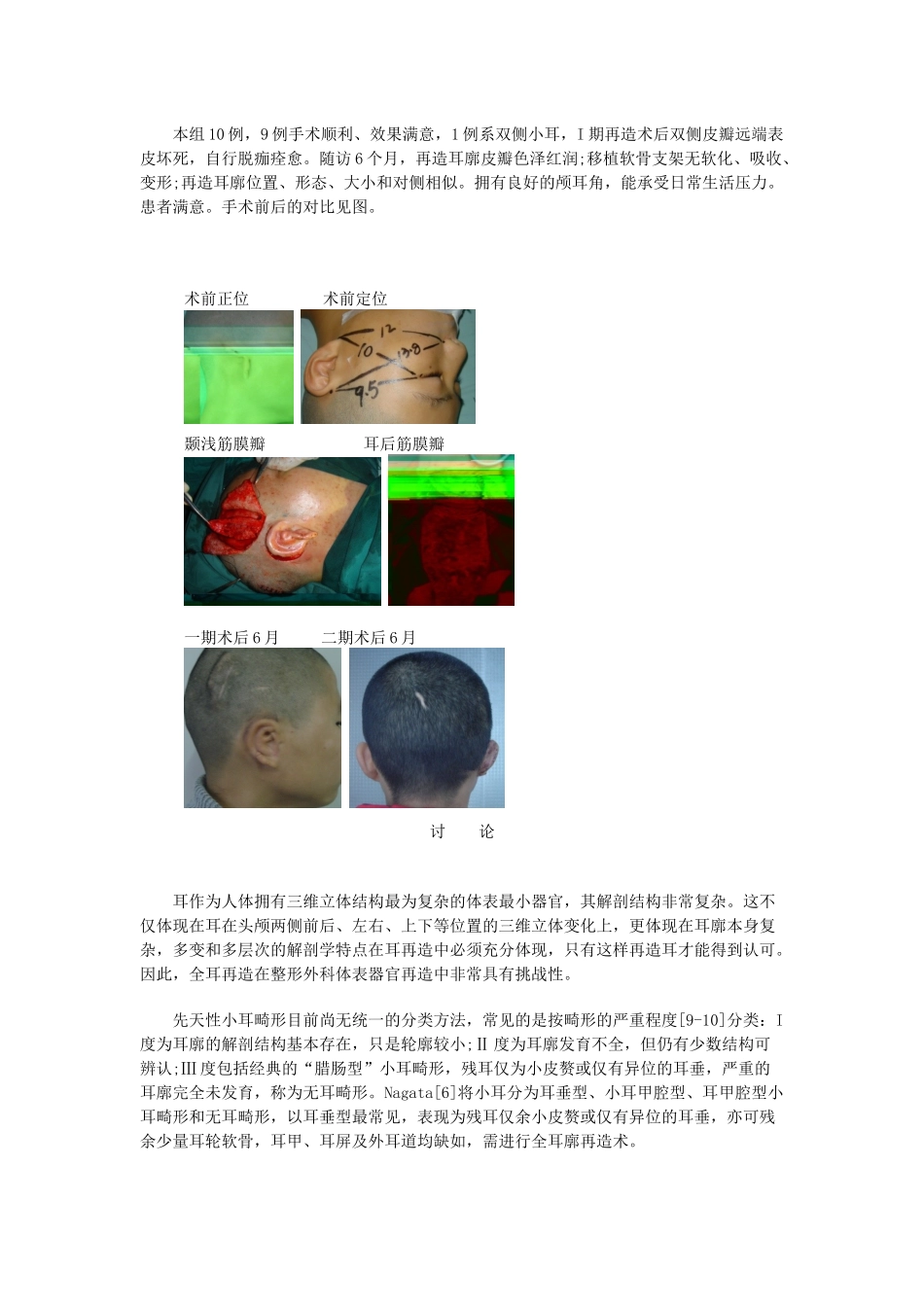 先天性小耳畸形的肋软骨全耳廓再造术_第3页