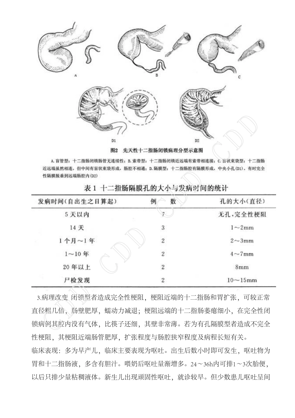 先天性十二指肠闭锁_第3页