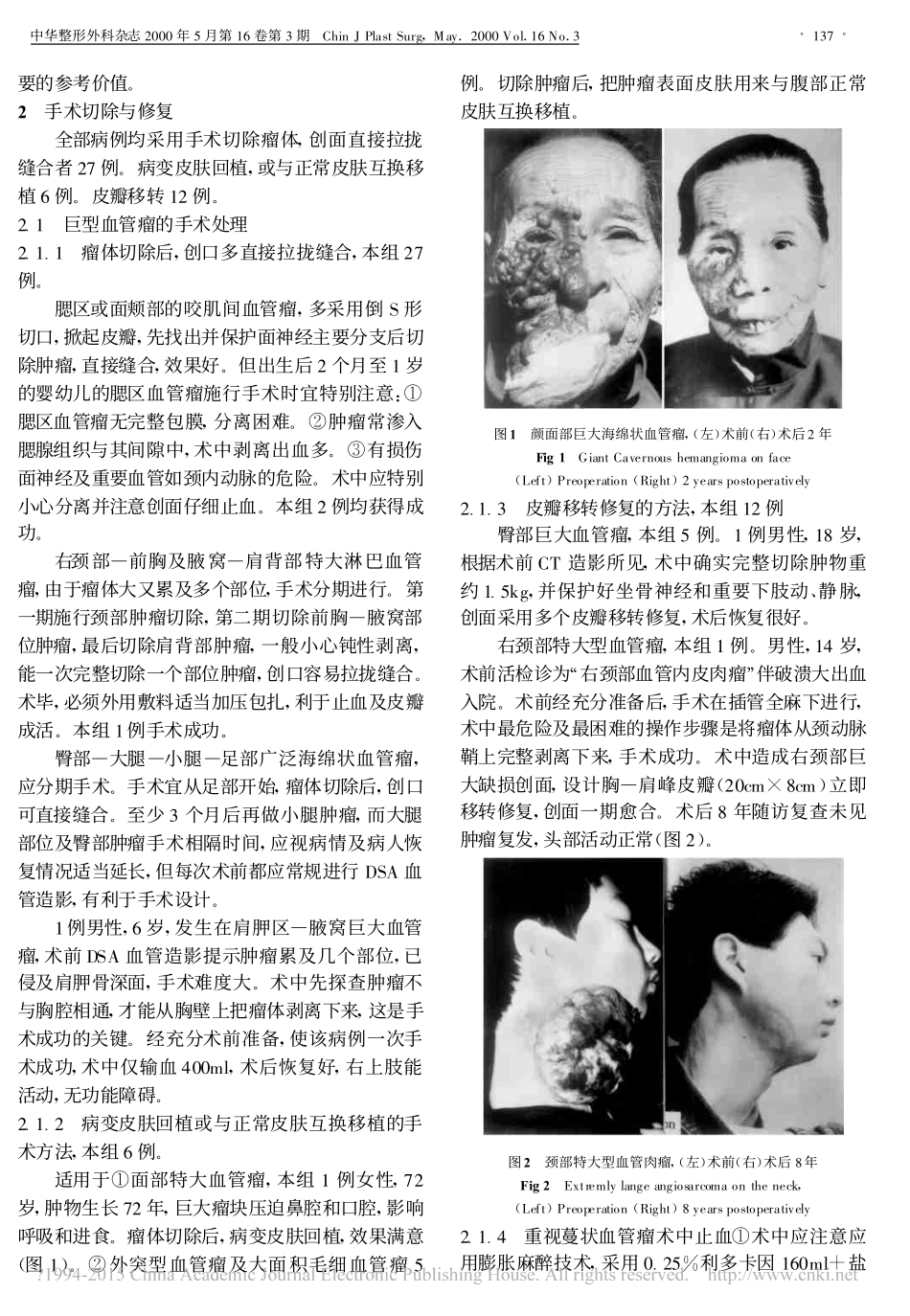 体表巨大血管瘤的手术切除与整复治疗_第2页
