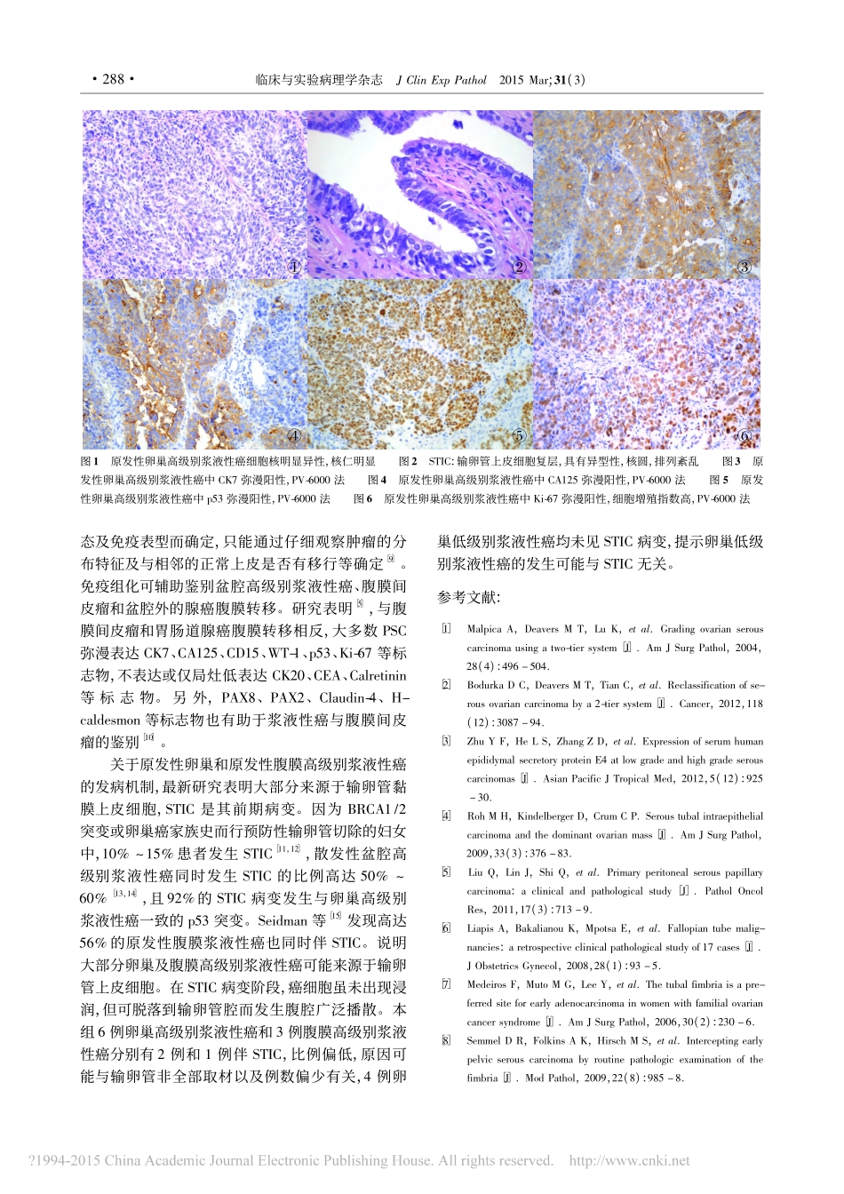 女性盆腔浆液性癌20例临床病理分析_石新兰_42496_第3页