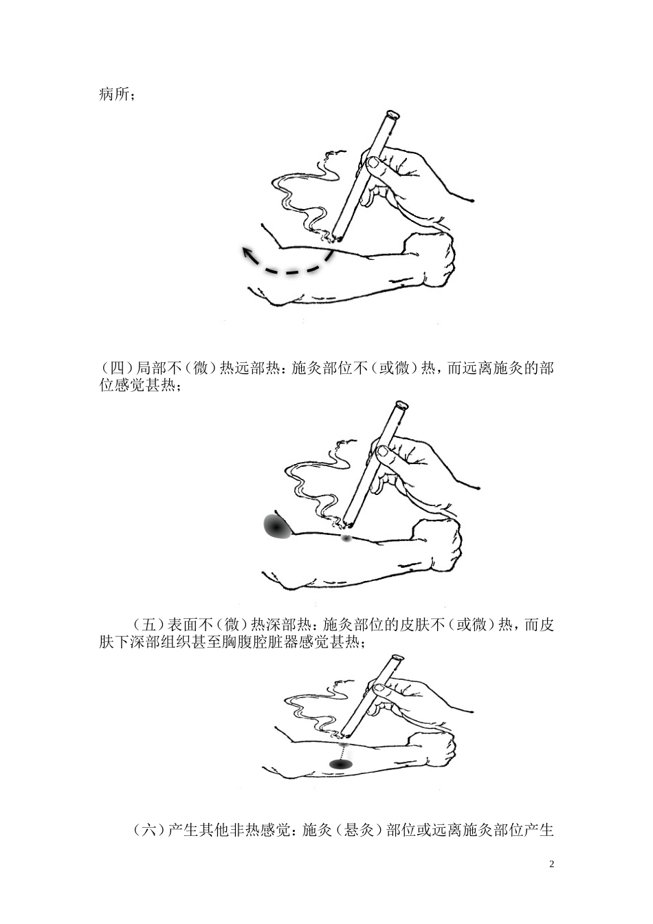 热敏灸治疗颈椎病技术===陈日新_第2页
