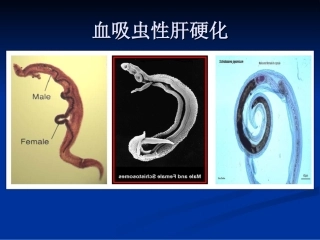 血吸虫性肝硬化CT表现