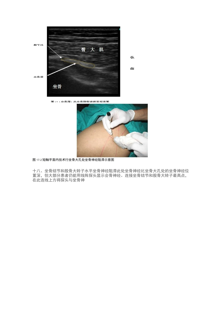 骶丛神经阻滞_第2页
