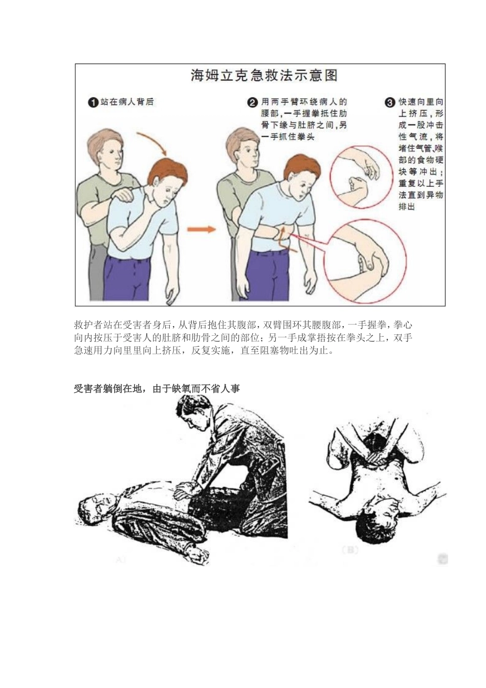 食物卡喉千万别拍背部!救了100多万人的“海姆立克急救法_第3页