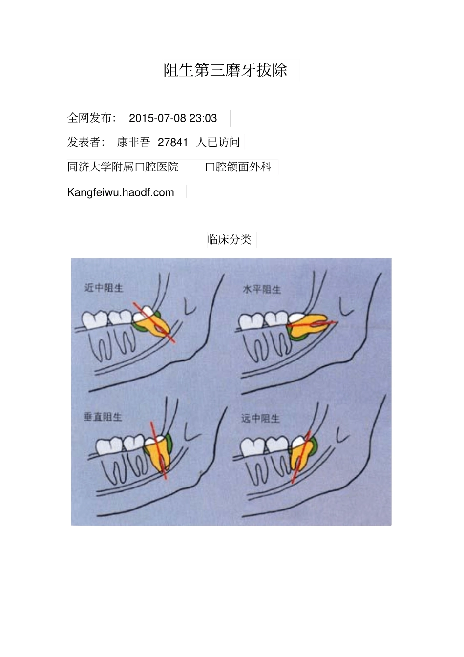 各种阻生牙的处理方法_第1页