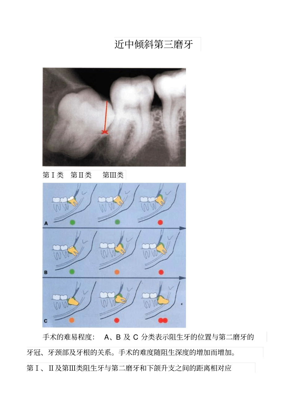 各种阻生牙的处理方法_第2页