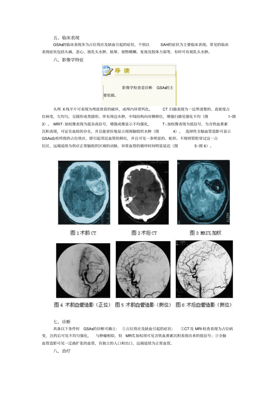 巨大蛇形动脉瘤的临床特点及治疗概要_第2页
