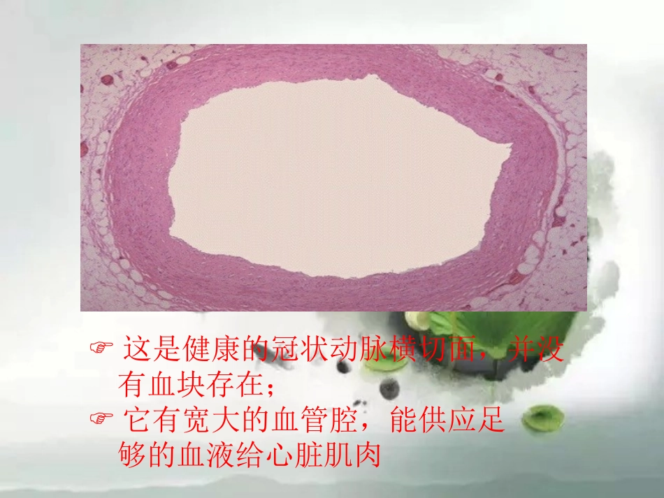 粥状动脉硬化及预防_第3页