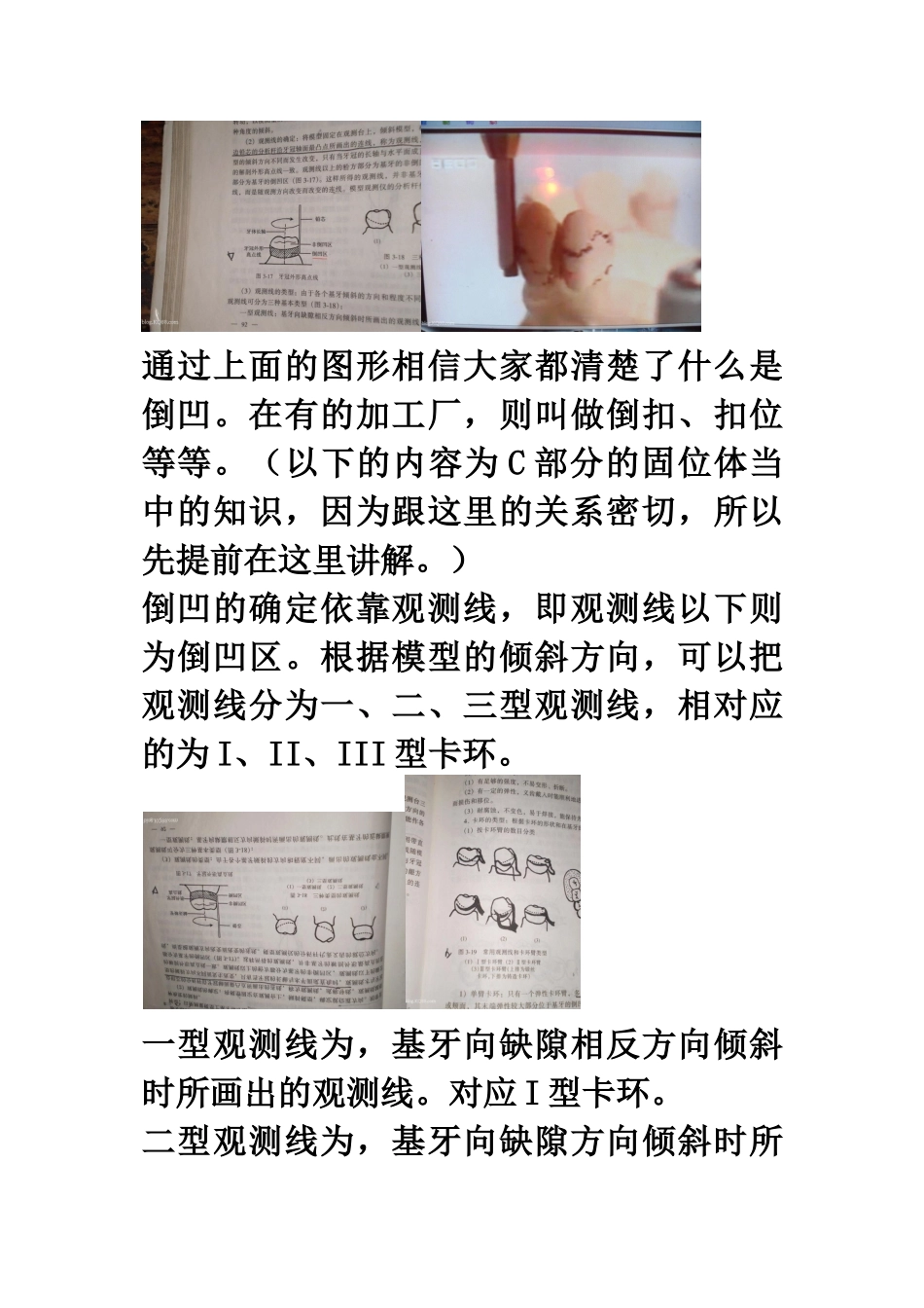 可摘局部义齿的设计方法总结_第3页