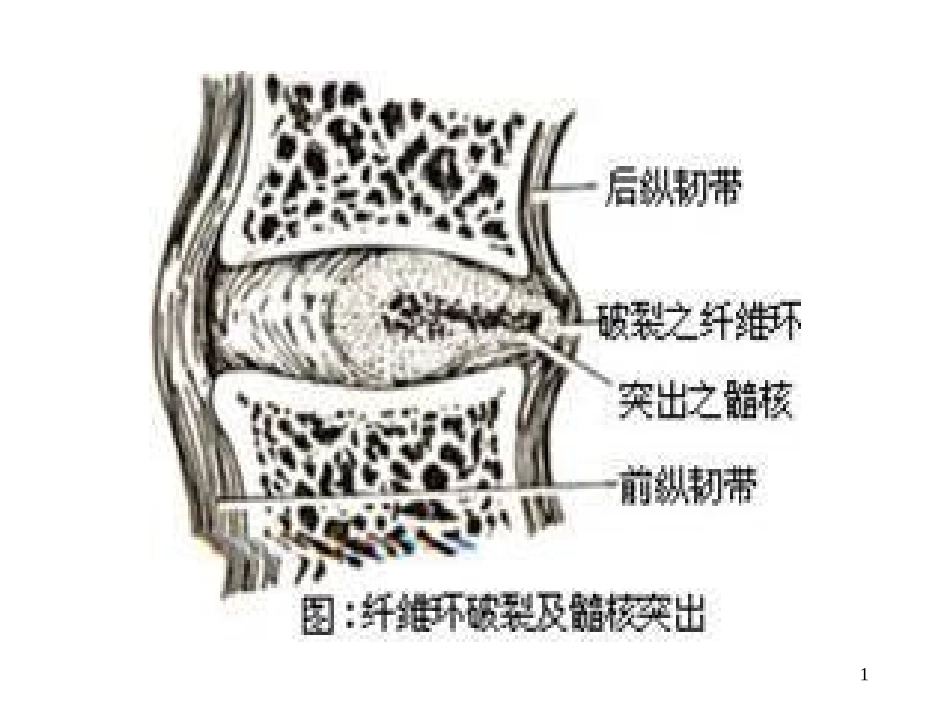 腰椎间盘突出症微创介入治疗3_第1页
