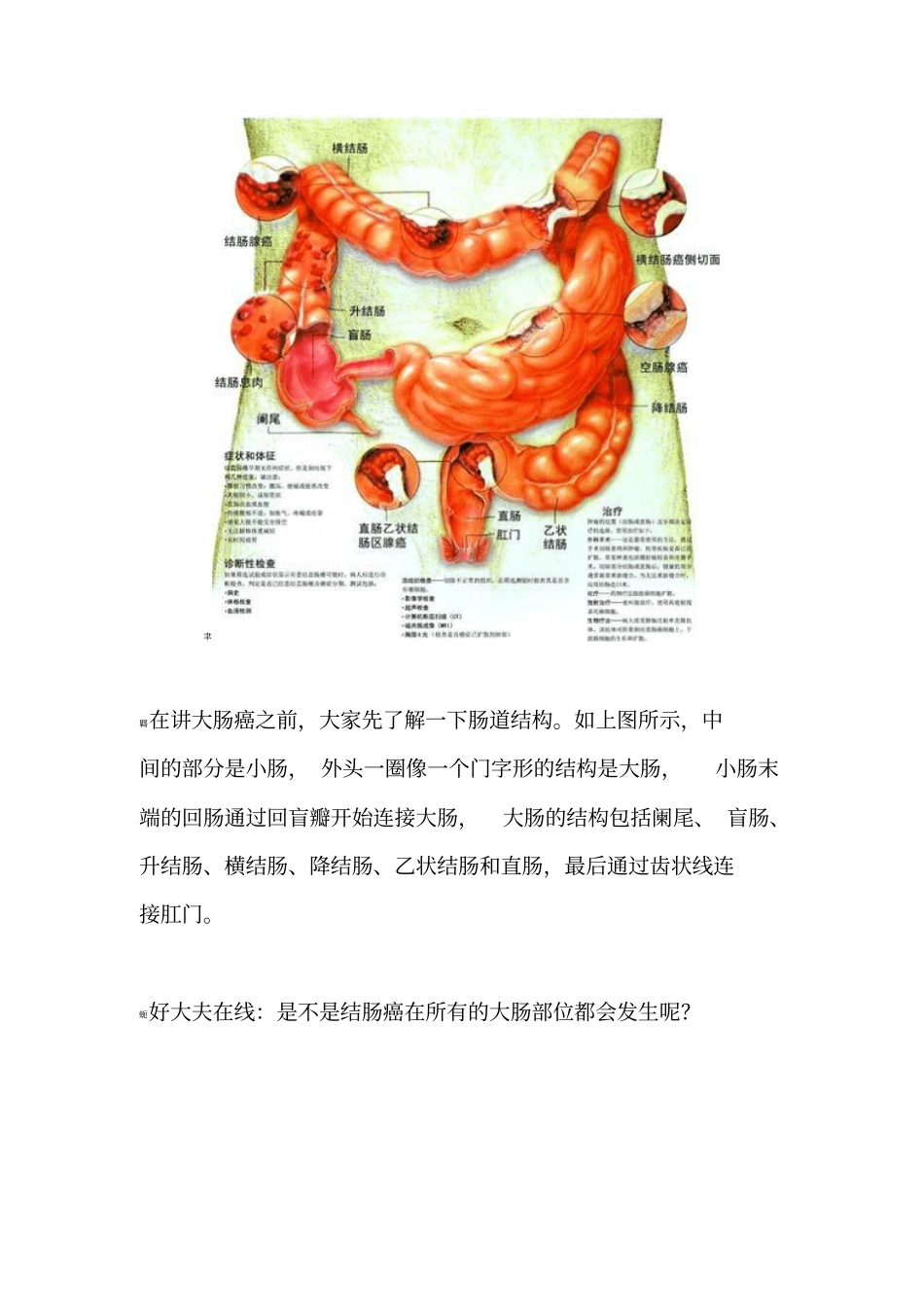 早期结肠癌治愈率可达95%_第2页