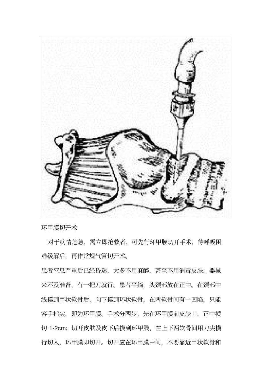 环甲膜穿刺和环甲膜切开术_第2页