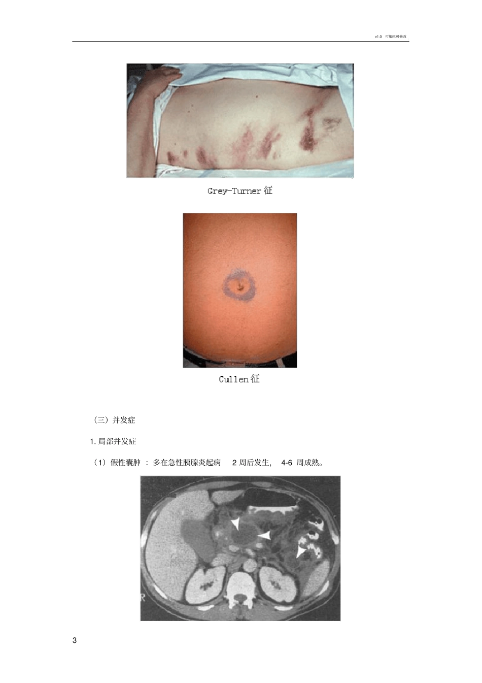 病例分析——急性胰腺炎_第3页