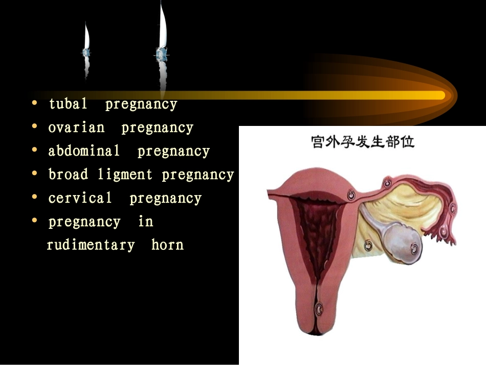 妇产科宫外孕培训讲义_第3页