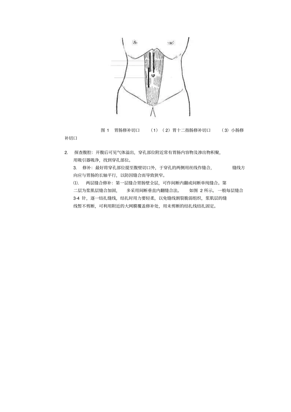 胃肠损伤或穿孔修补术_第2页