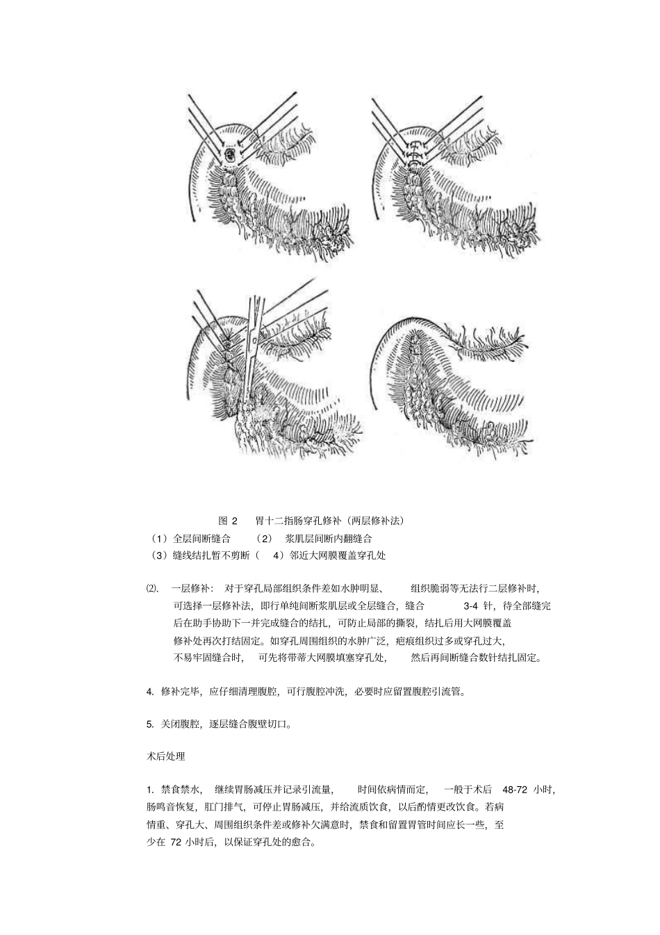 胃肠损伤或穿孔修补术_第3页
