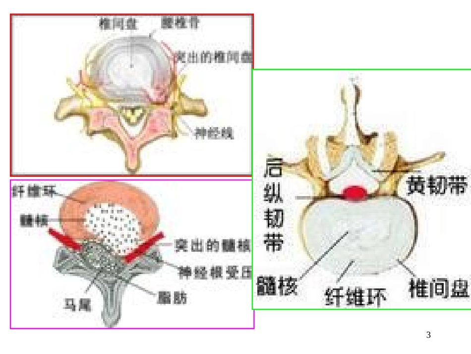 腰椎间盘突出症微创介入治疗4_第3页
