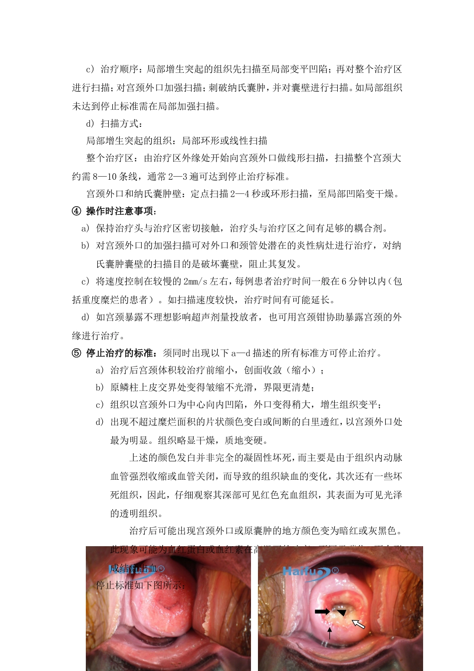 CZF治疗宫颈炎的临床操作规范(新)_第3页