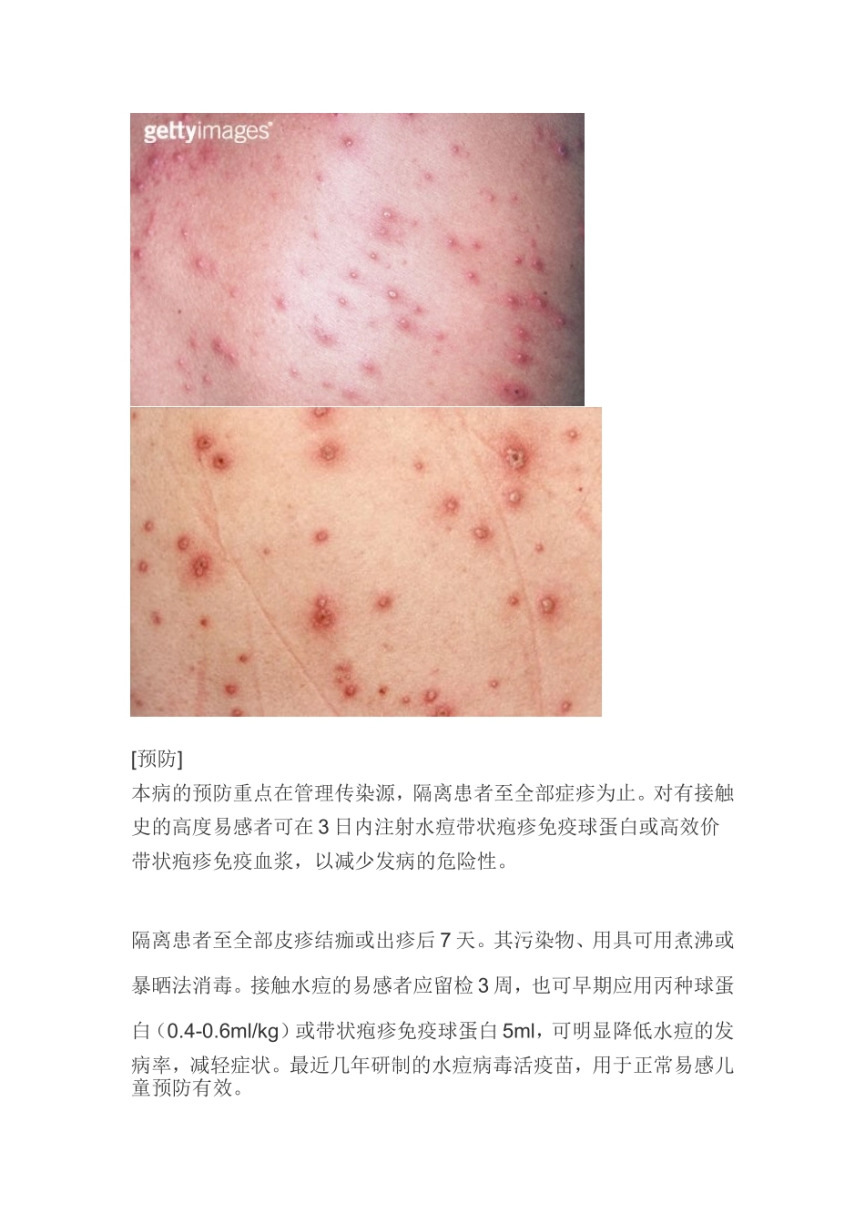 水痘的临床表现及预防附有图片_第3页