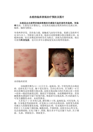 水痘的临床表现及预防附有图片