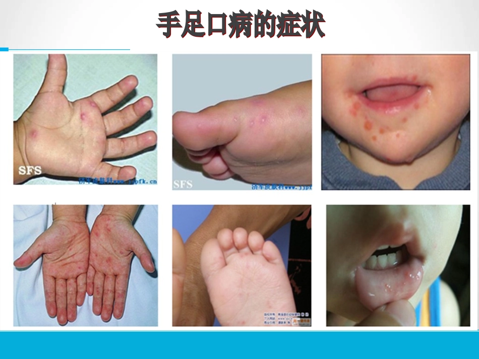 《手足口病的预防》胡晓敏龙岗智鑫幼儿园_第2页