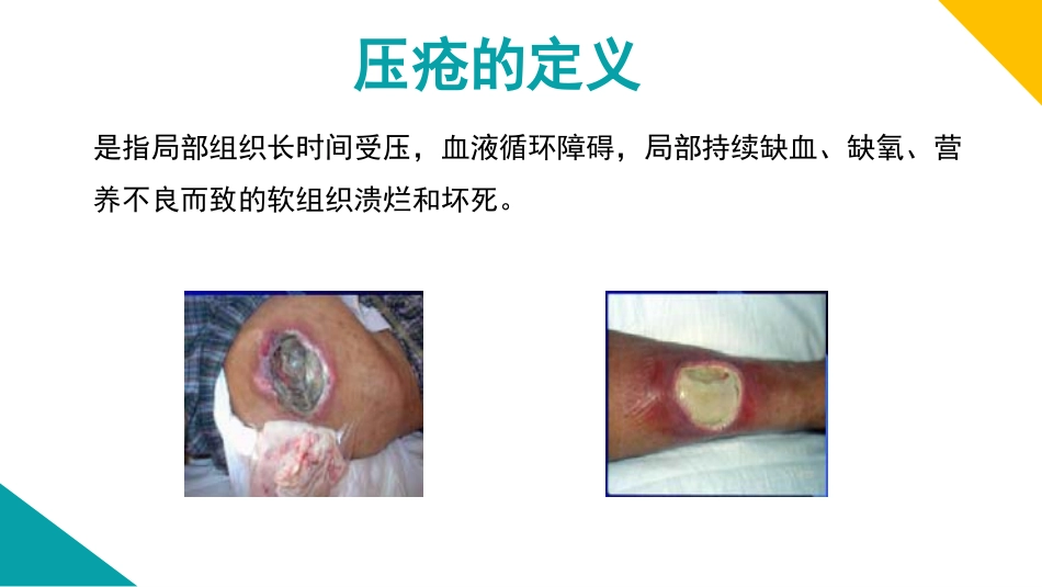 压疮病人的护理_第2页