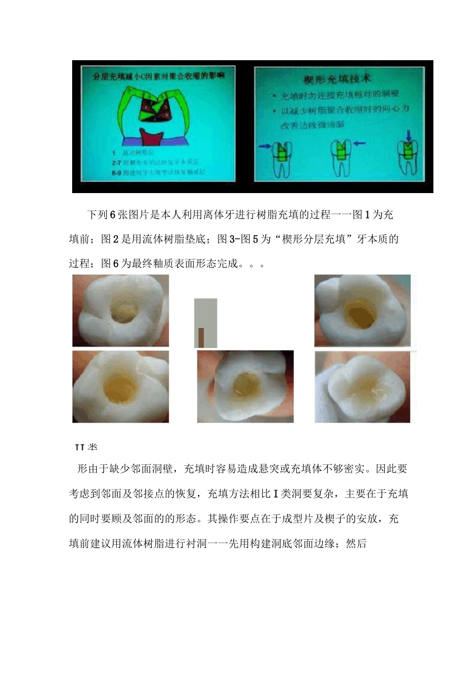 图解各类洞形树脂充填方法_第2页