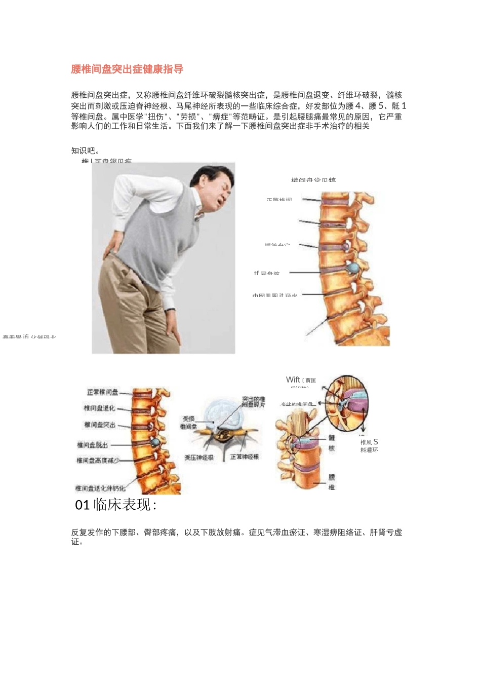 腰椎间盘突出症健康指导_第1页