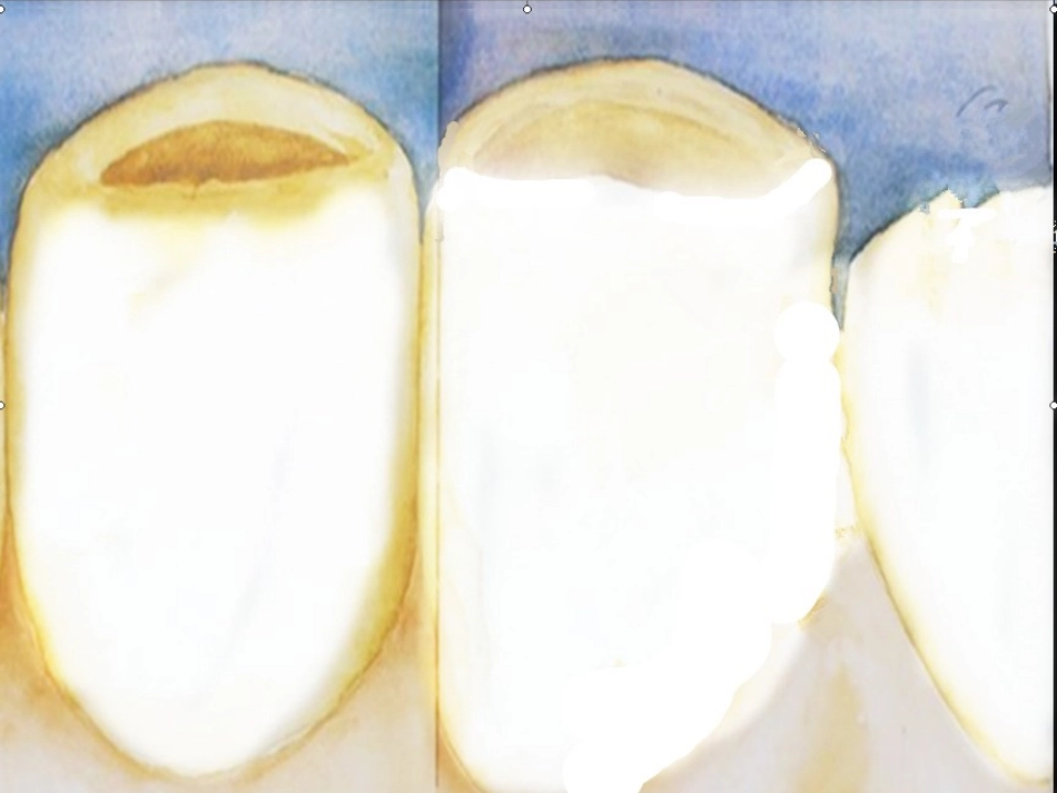 牙齿上的小洞洞_第2页