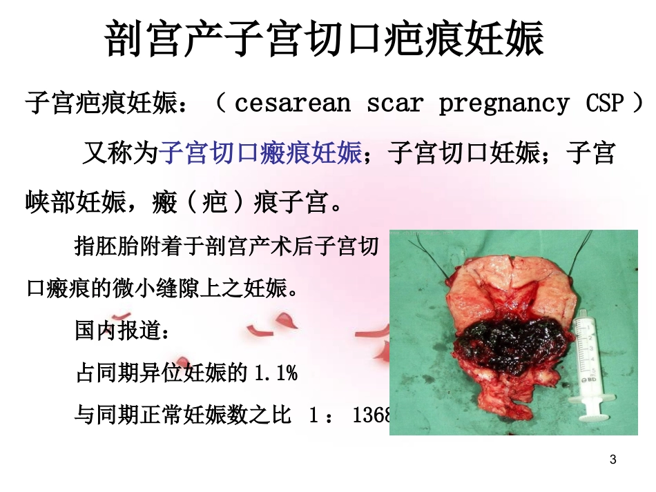 疤痕妊娠的影像学诊断课件_第3页