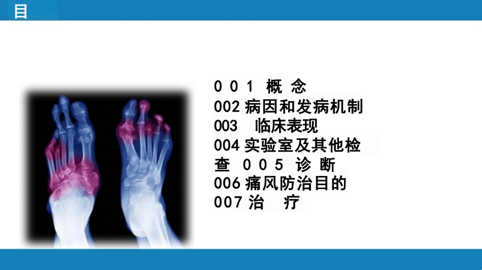 痛风课件模板_第3页