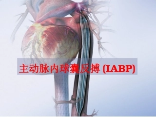 主动脉内球囊反搏(IABP)