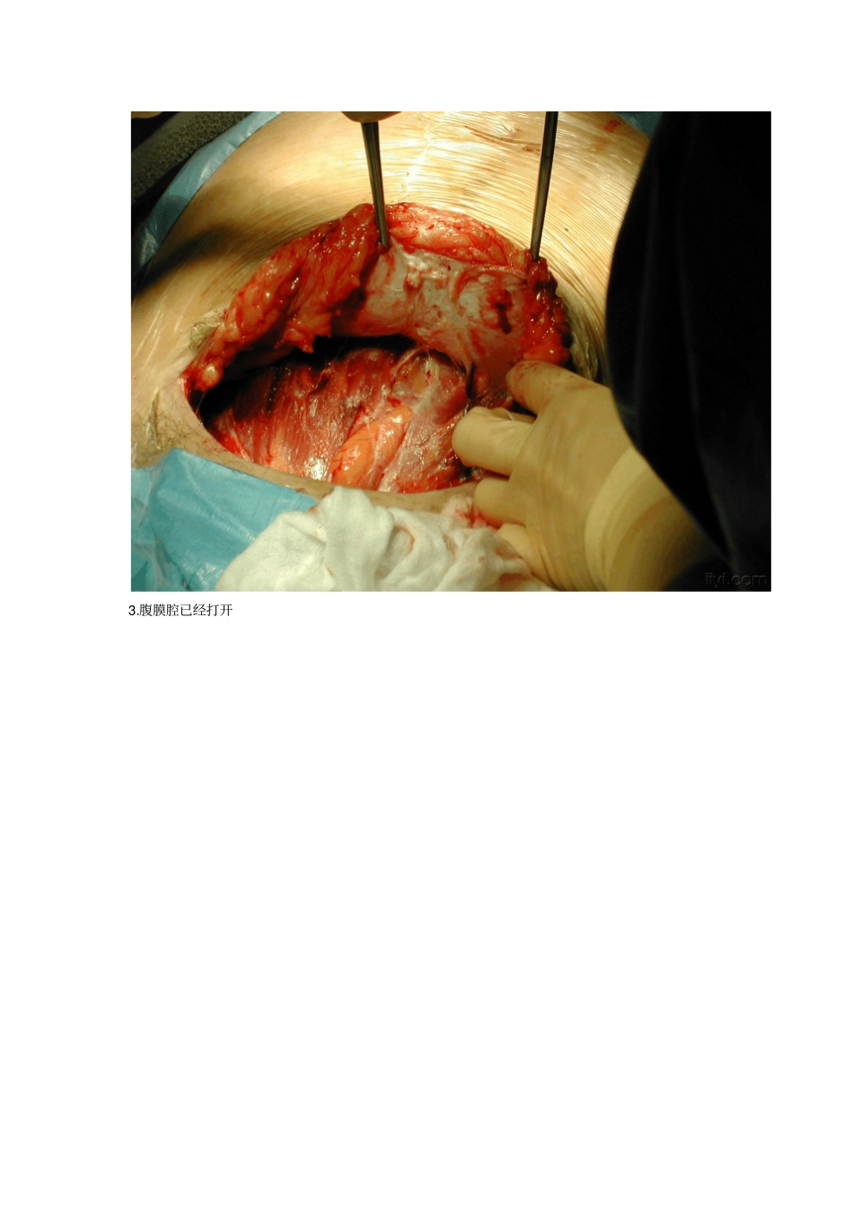 一组高清晰剖腹产手术照片复习_第2页
