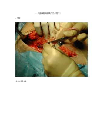 一组高清晰剖腹产手术照片复习