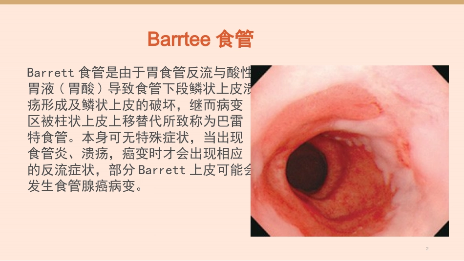 Barrett食管完整课件_第2页