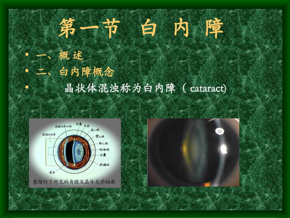 白内障完整课件_第2页