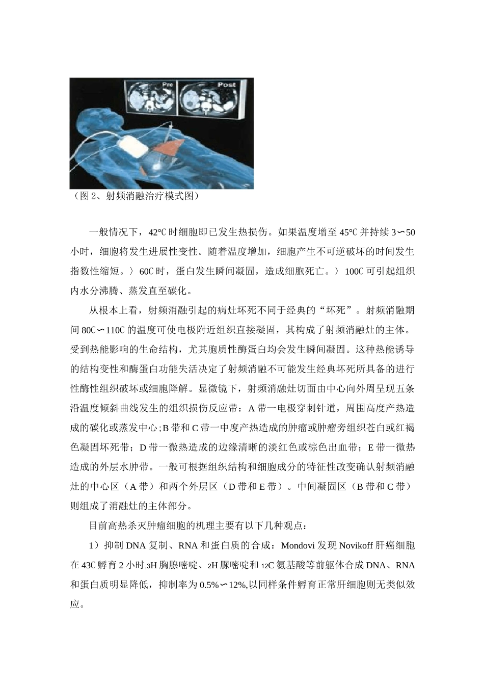 肝癌射频消融资料_第2页