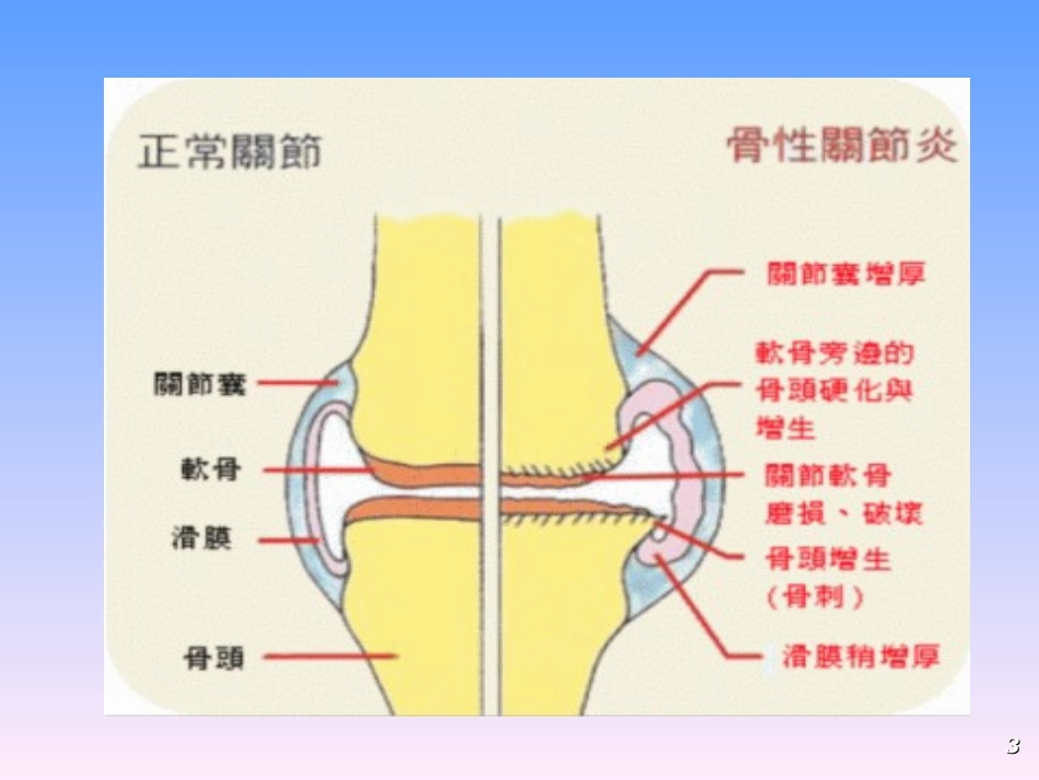 骨关节炎防治指导_第3页