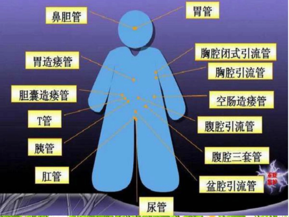 导管的滑脱的预防_第2页