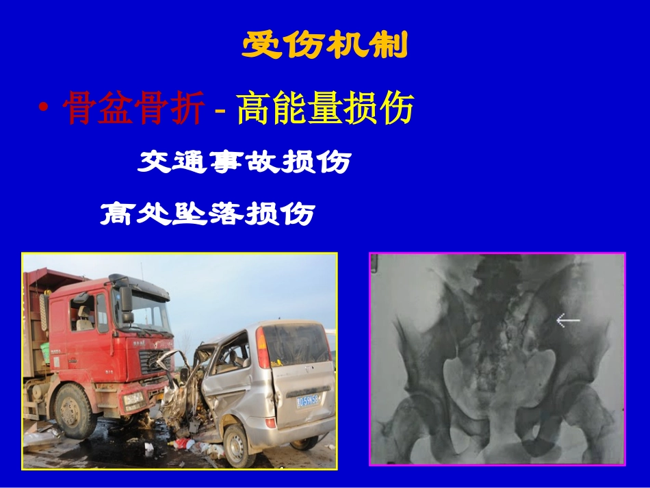 2017骨盆骨折的处理指南_第3页