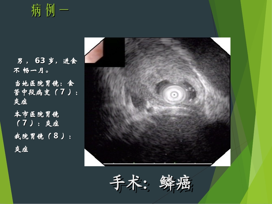 【PPT课件】消化道黏膜隆起性病变的超声内镜诊断_第2页