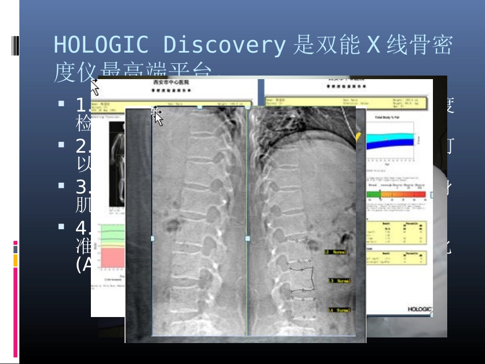 hologic双能x线骨密度仪介绍_第2页