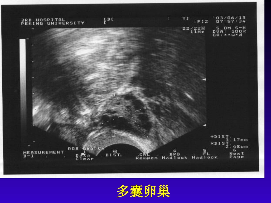 B超监测卵泡发育_第3页