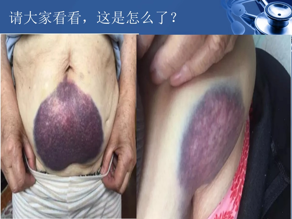 低分子肝素钙的规范化注射方法_第2页