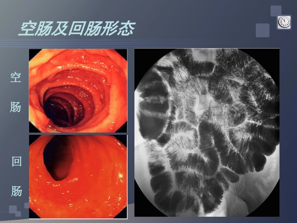 肠道疾病CT诊断_第3页