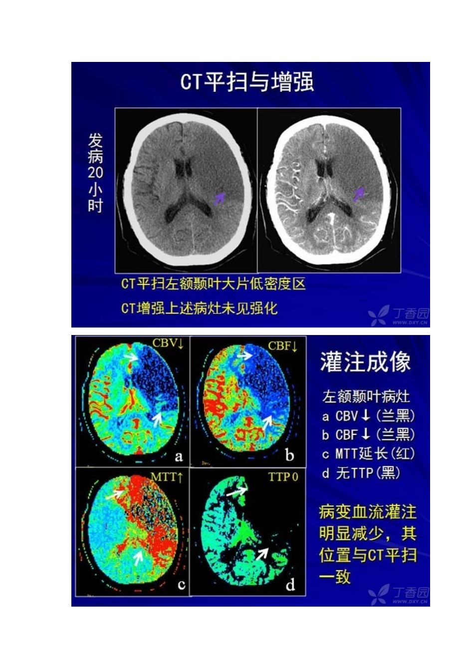 脑缺血CT灌注基础知识_第3页